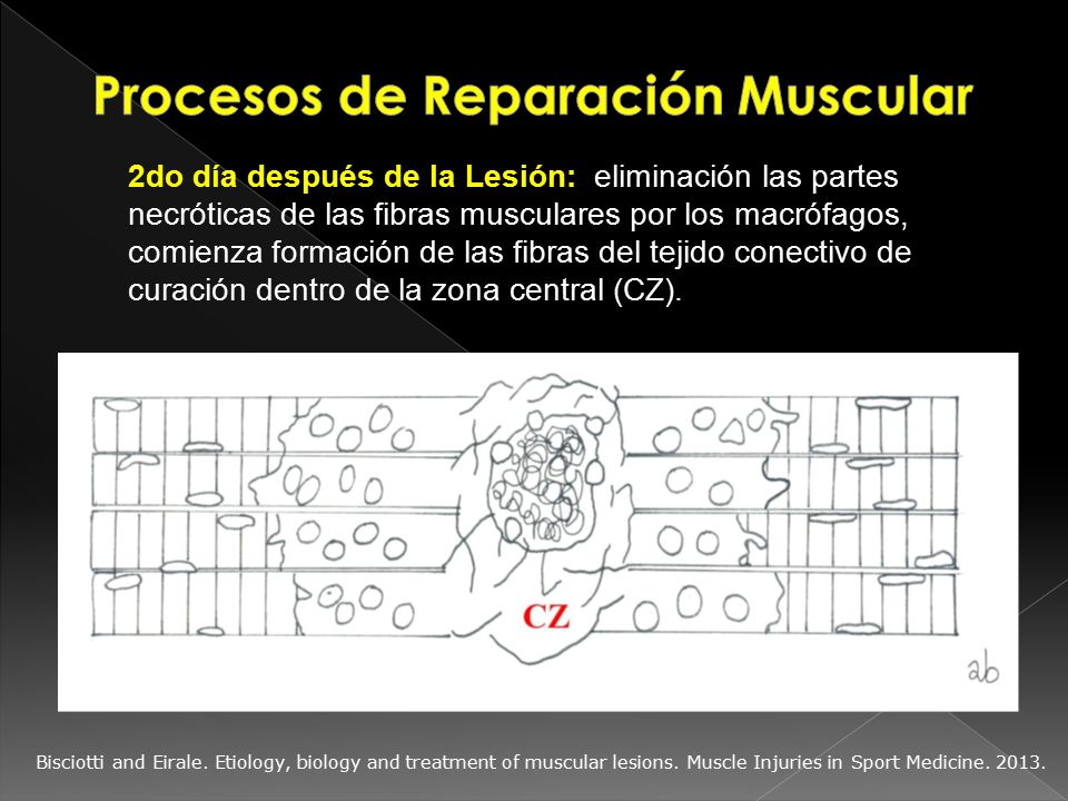 rotura de fibras musculares