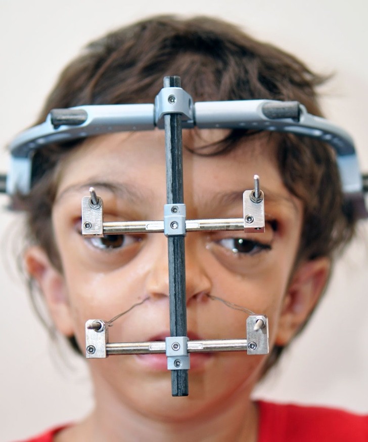 Síndrome de Crouzon