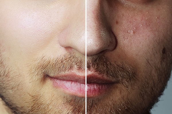 peeling facial para hombres