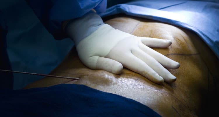 Lipoescultura, ¿es para mí?