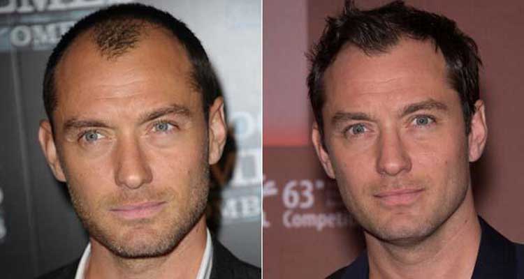 Ellos también se están quedando calvos