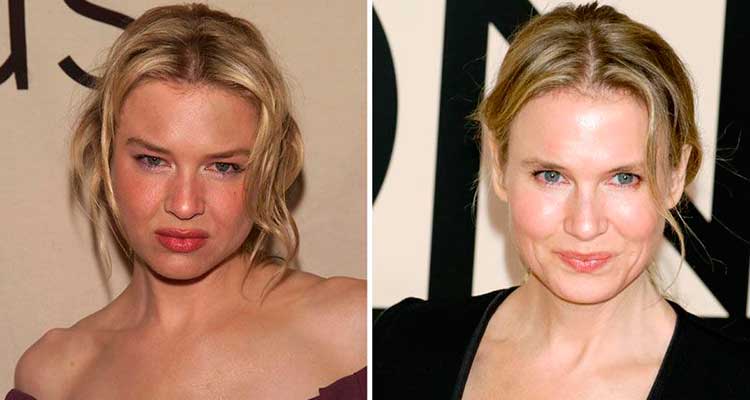 Los famosos peor operados