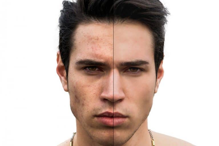 Cuidados básicos masculinos para la piel grasa