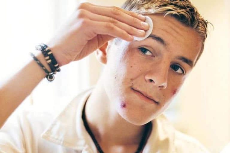 Trucos para combatir el acné veraniego